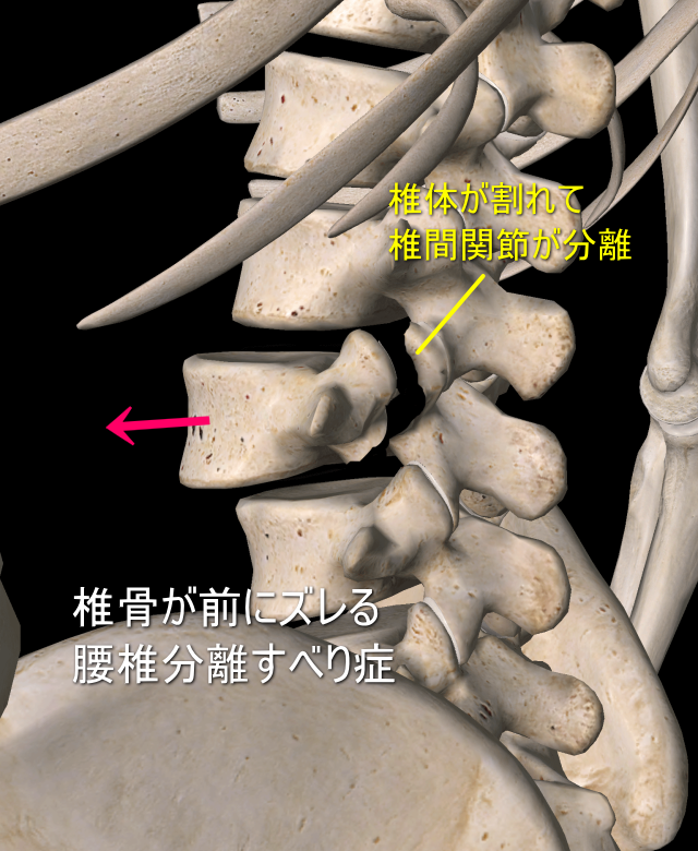 腰椎分離すべり症 茅ヶ崎 辻堂の整体 医療関係者も通う アライカイロプラクティックオフィス